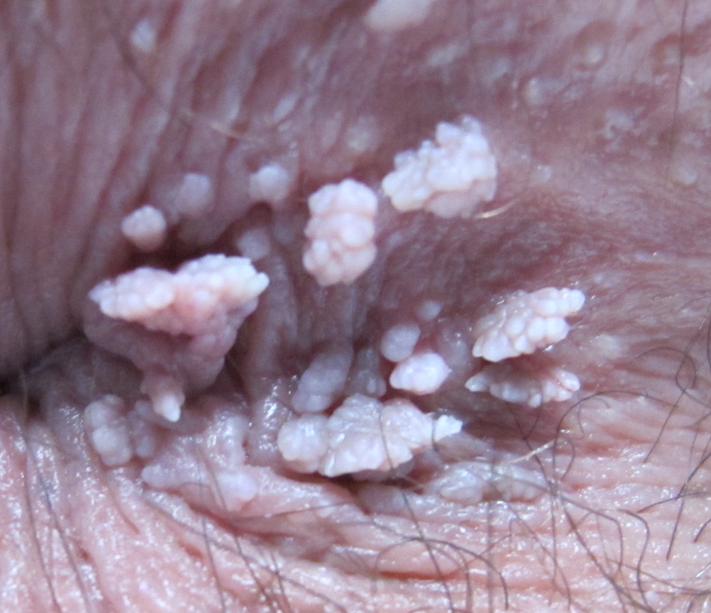 Photo clinique en gros plan : autour de l’anus, une dizaine de petites excroissances blanc rosé, granuleuses, en forme de chou-fleur.