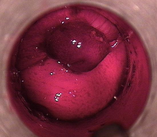 Vue à travers l’anuscope : une boule de muqueuse rouge sombre, serrée à sa base par un anneau élastique.