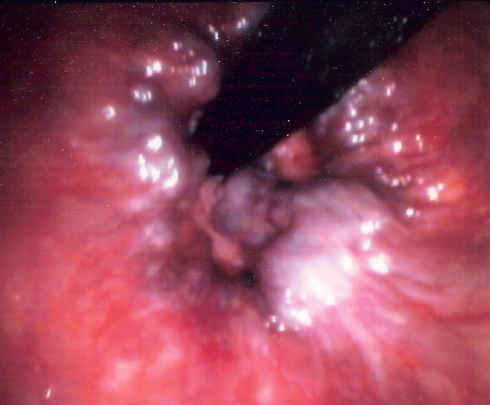 Vue endoscopique de l’intérieur du rectum, tournée vers l’anus : des bourrelets rouge sombre entourent le canal anal.