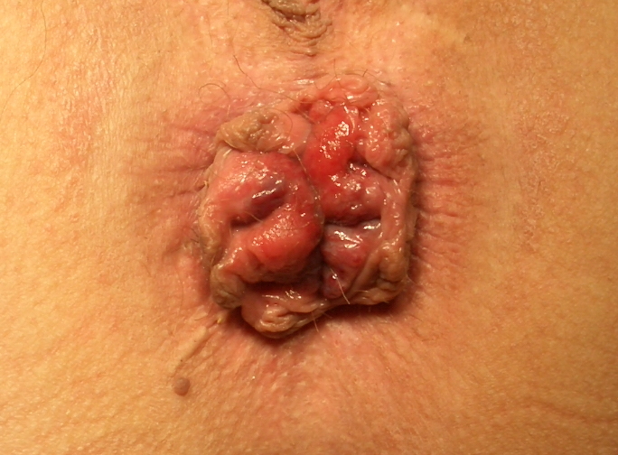 Photo clinique en gros plan : une masse de bourrelets roses et rouges, humides, sort de l’anus.