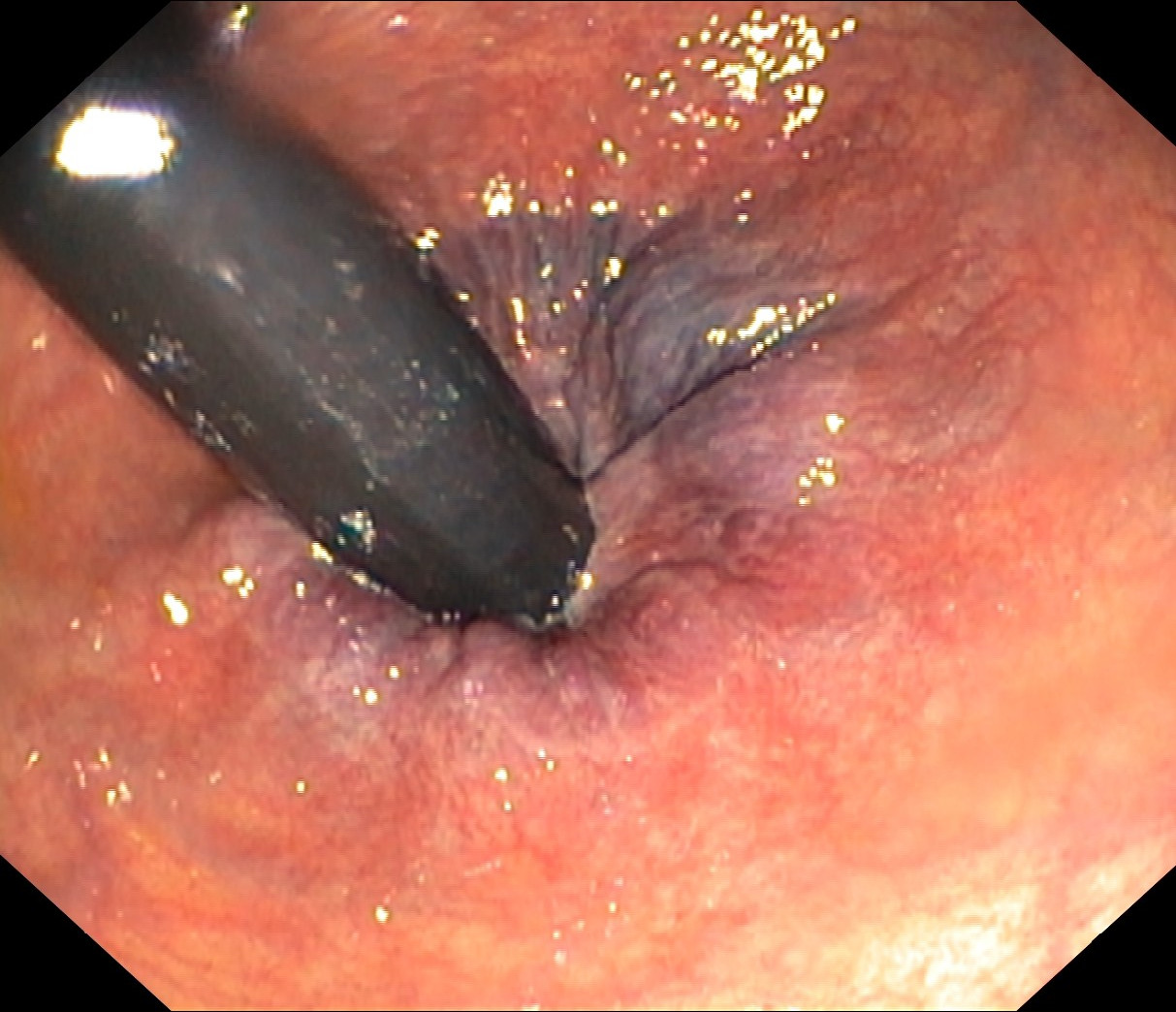Vue d’endoscopie depuis le rectum, tournée vers l’anus : l’endoscope noir traverse le canal, entouré de bourrelets violacés.