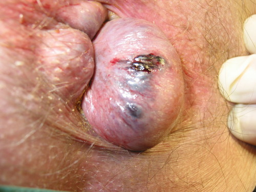 Photo clinique : au bord de l’anus, une grosse boule violacée et tendue, dont la surface montre de petites taches noires et un peu de sang.
