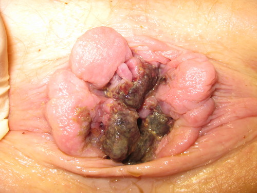 Photo clinique : tout autour de l’anus, des hémorroïdes internes sorties, gonflées, rouge sombre, avec des zones noirâtres en surface.