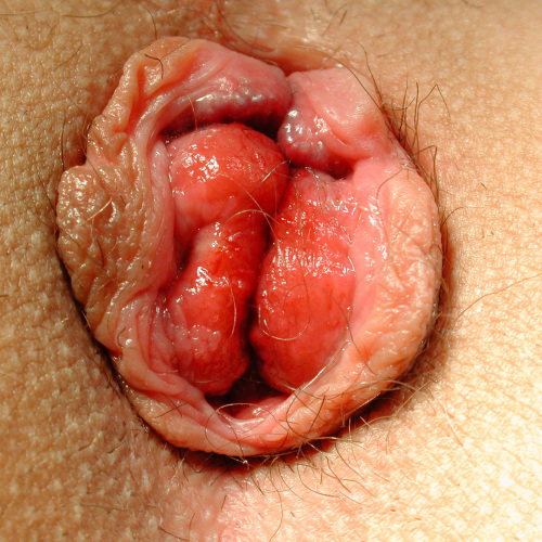 Photo en gros plan d’un anus d’où sortent plusieurs paquets rouge framboise, séparés par des sillons, entourés d’une collerette de peau plissée.