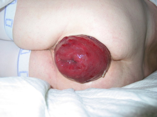 Photo d’une patiente couchée sur le côté : une masse ronde, rouge sombre et luisante, de la taille d’une orange, sort de l’anus.