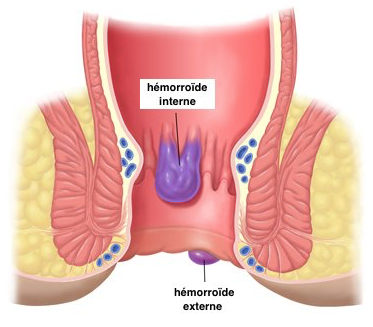 hemorroides internes - veines situées à l'intérieur de la paroi anale